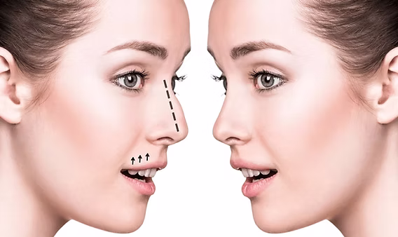 Understanding the Rhinoplasty Recovery Journey at Tajmeels Clinic Dubai